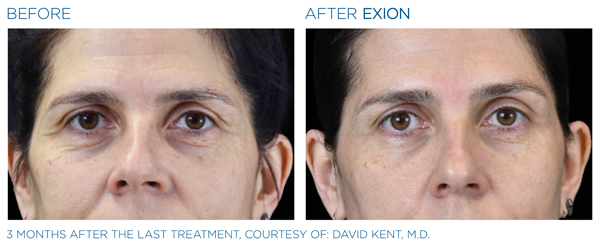 Before & After - Eyes 1