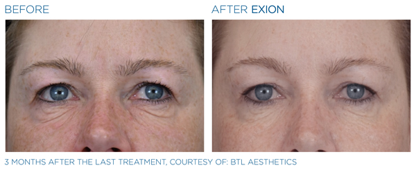 Before & After - Eyes 3