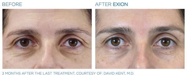 Before & After - Eyes 4