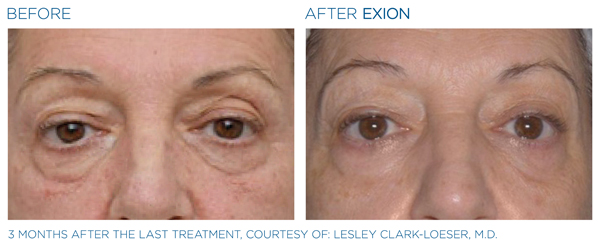 Before & After - Eyes 5