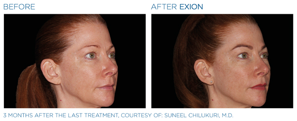 Before & After - Full Face 2