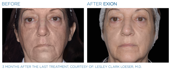 Before & After - Full Face 3